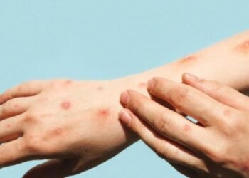 Mpox cases are increasing; health vigilance is being strengthened in the UAE.