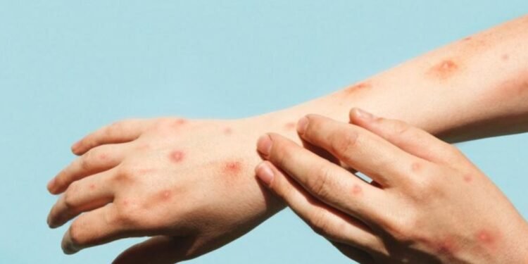 Mpox cases are increasing; health vigilance is being strengthened in the UAE.