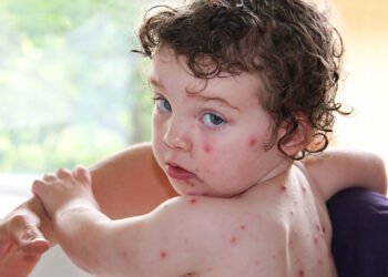 40 ദിവസത്തിനിടെ 5,791 പേർക്ക് ചിക്കൻപോക്സ്; സംസ്ഥാനത്ത് രോഗബാധിതരുടെ എണ്ണം വർധിക്കുന്നു