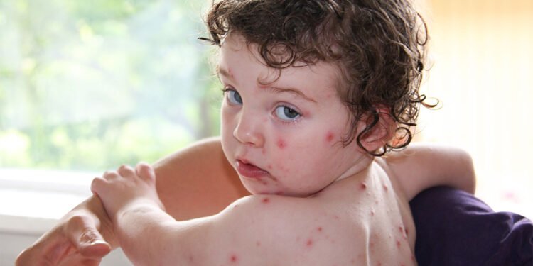 40 ദിവസത്തിനിടെ 5,791 പേർക്ക് ചിക്കൻപോക്സ്; സംസ്ഥാനത്ത് രോഗബാധിതരുടെ എണ്ണം വർധിക്കുന്നു